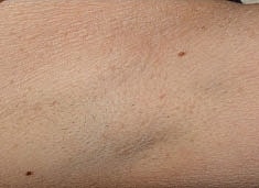 Laser Hair Removal Before & After