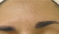 Hydrafacial Before & After