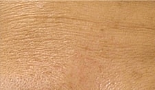 Hydrafacial Before & After