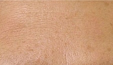 Hydrafacial Before & After
