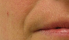 Hydrafacial Before & After
