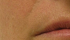 Hydrafacial Before & After