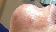 Hydrafacial Before & After