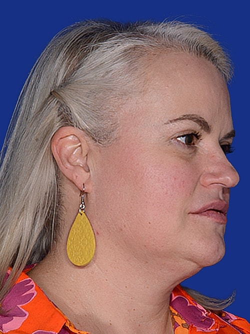 Neck Lift Before & After