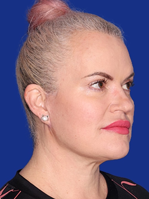 Neck Lift Before & After