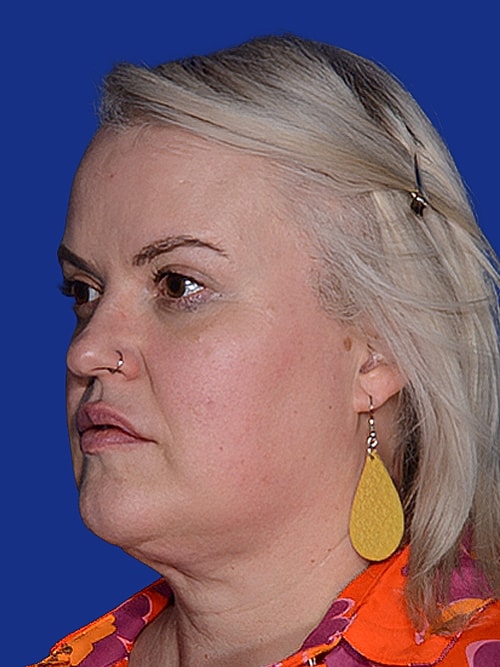 Neck Lift Before & After
