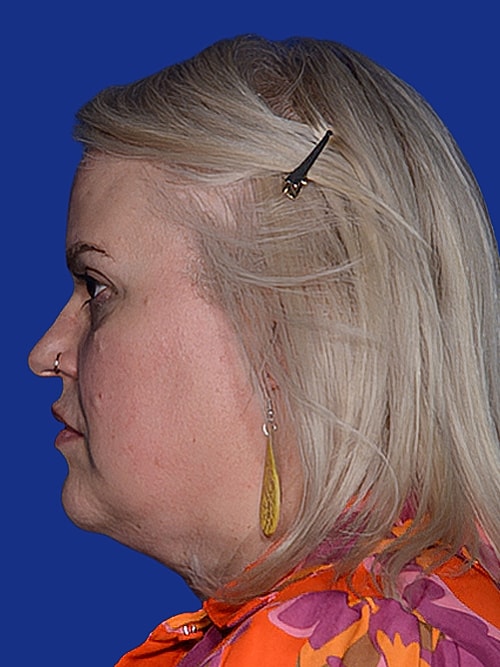 Neck Lift Before & After