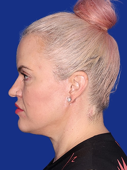 Neck Lift Before & After
