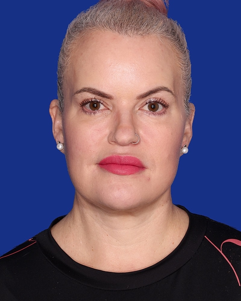 Neck Lift Before & After