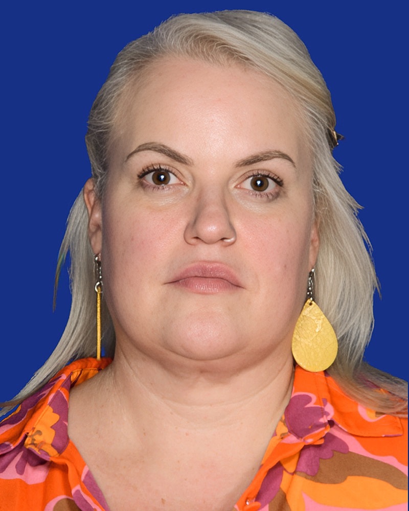 Neck Lift Before & After