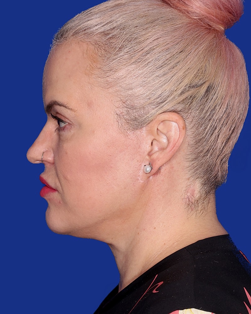 Neck Lift Before & After