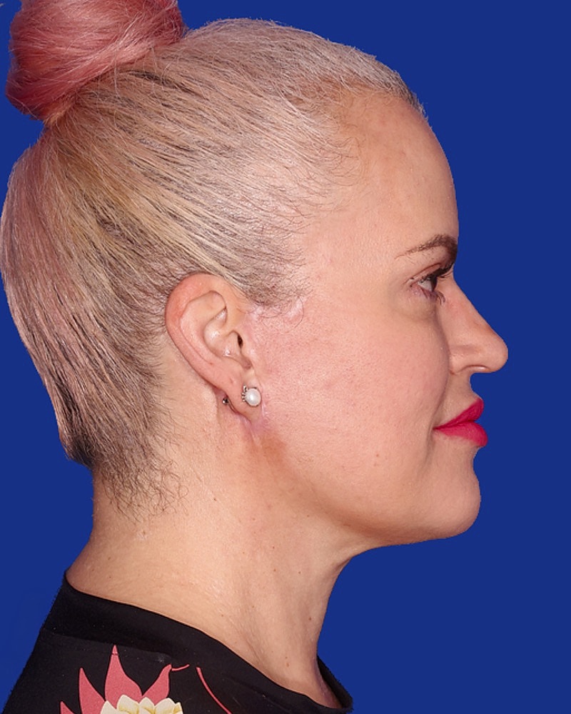 Neck Lift Before & After