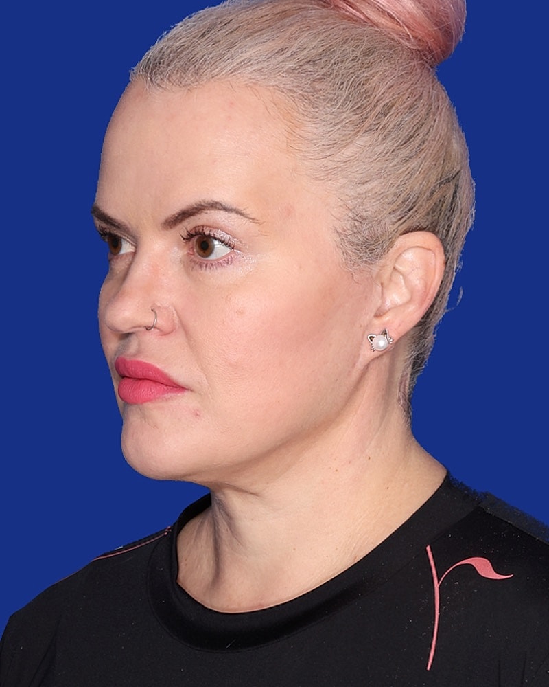 Neck Lift Before & After