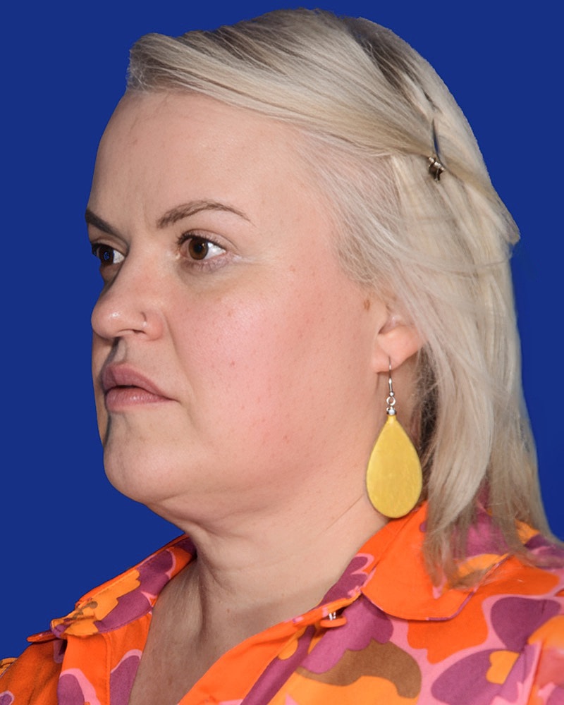 Neck Lift Before & After