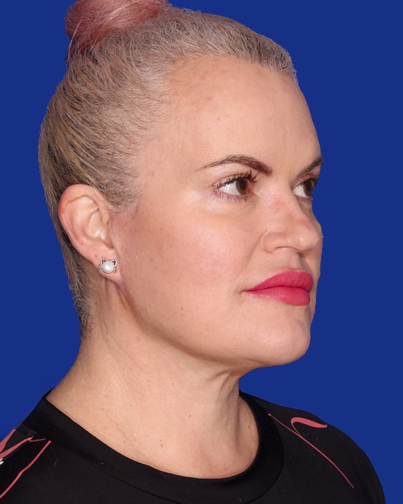 Neck Lift Before & After