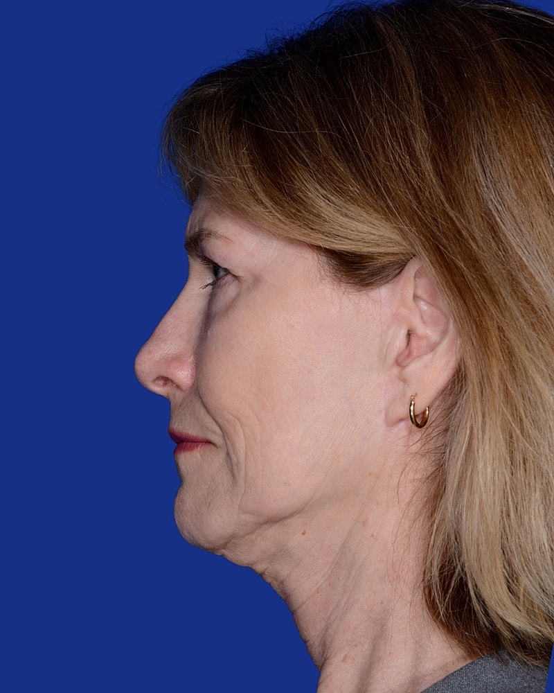 Neck Lift Before & After