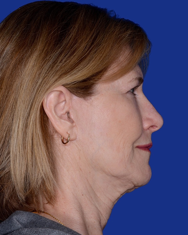 Neck Lift Before & After
