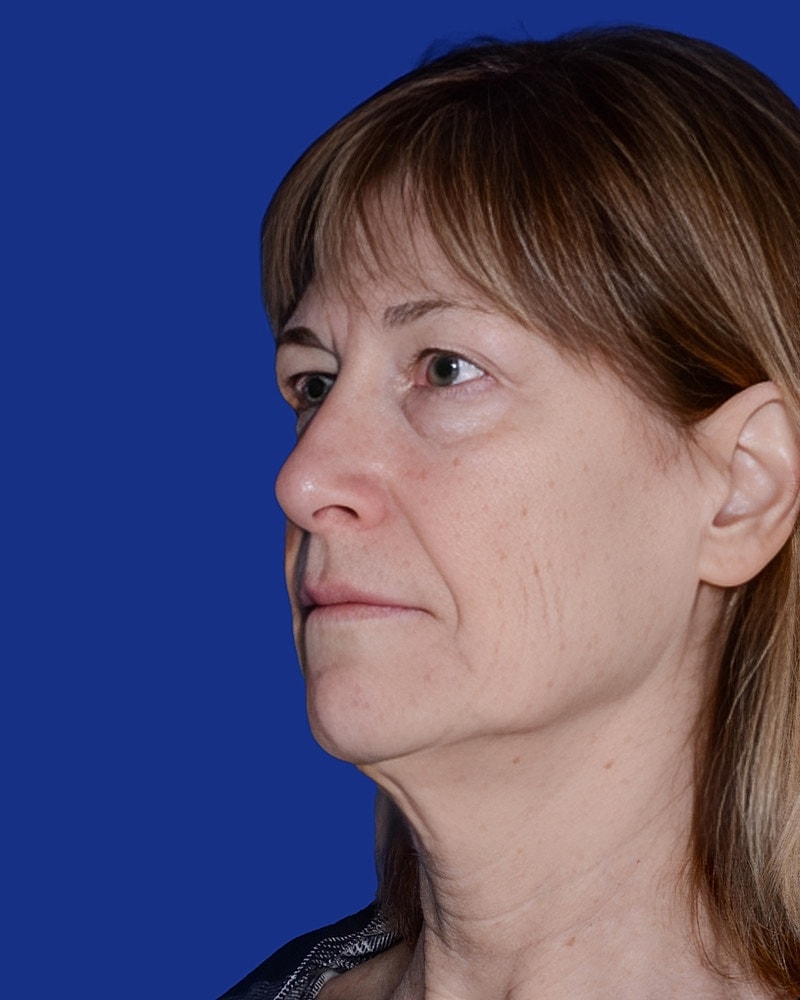 Neck Lift Before & After