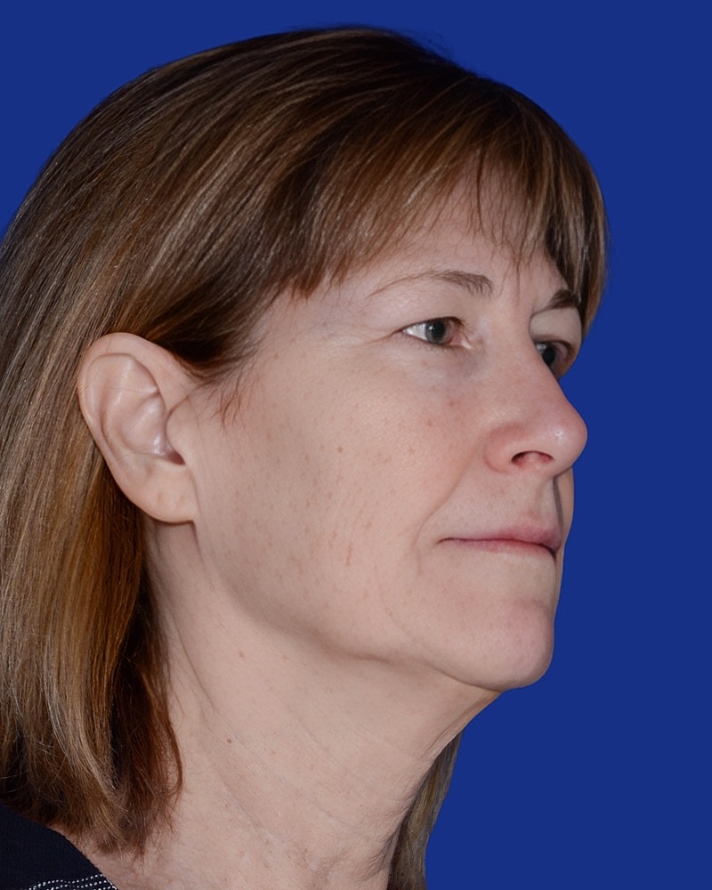 Neck Lift Before & After