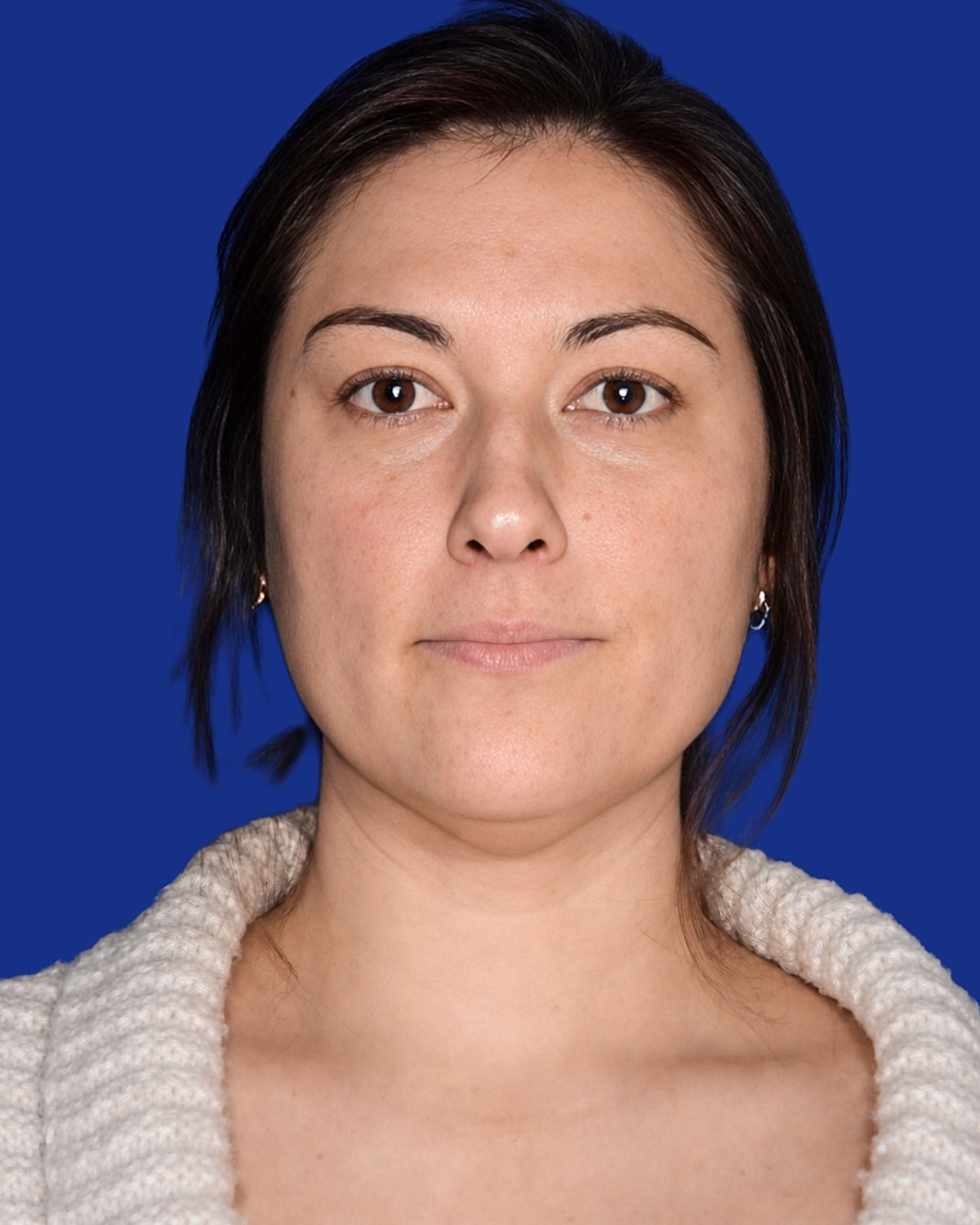 Neck Lift Before & After