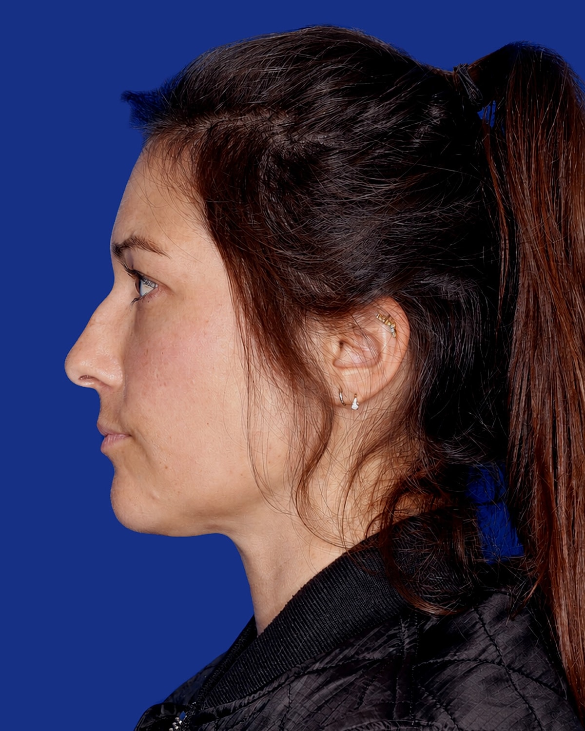 Neck Lift Before & After