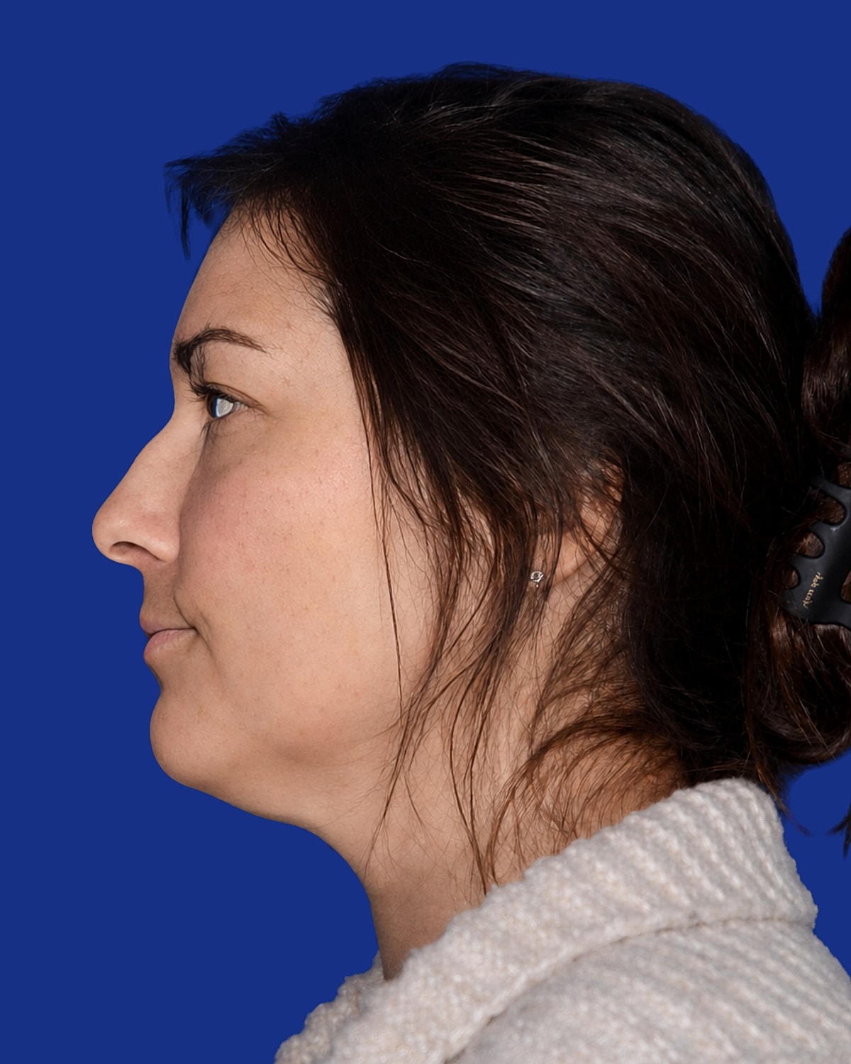 Neck Lift Before & After