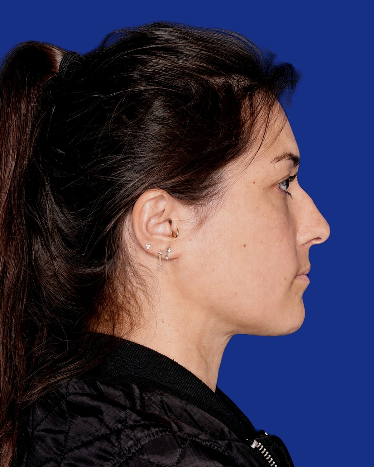 Neck Lift Before & After