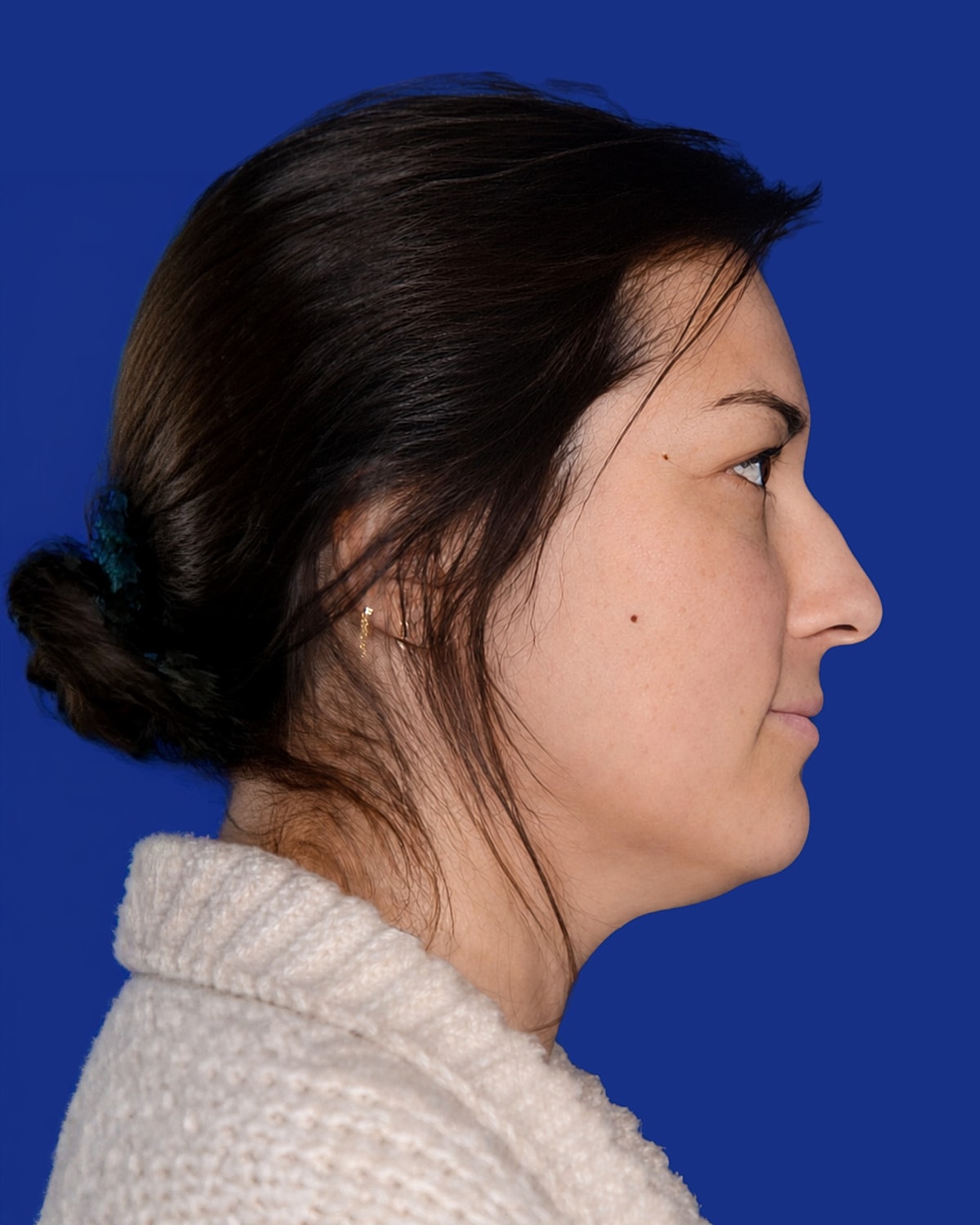 Neck Lift Before & After