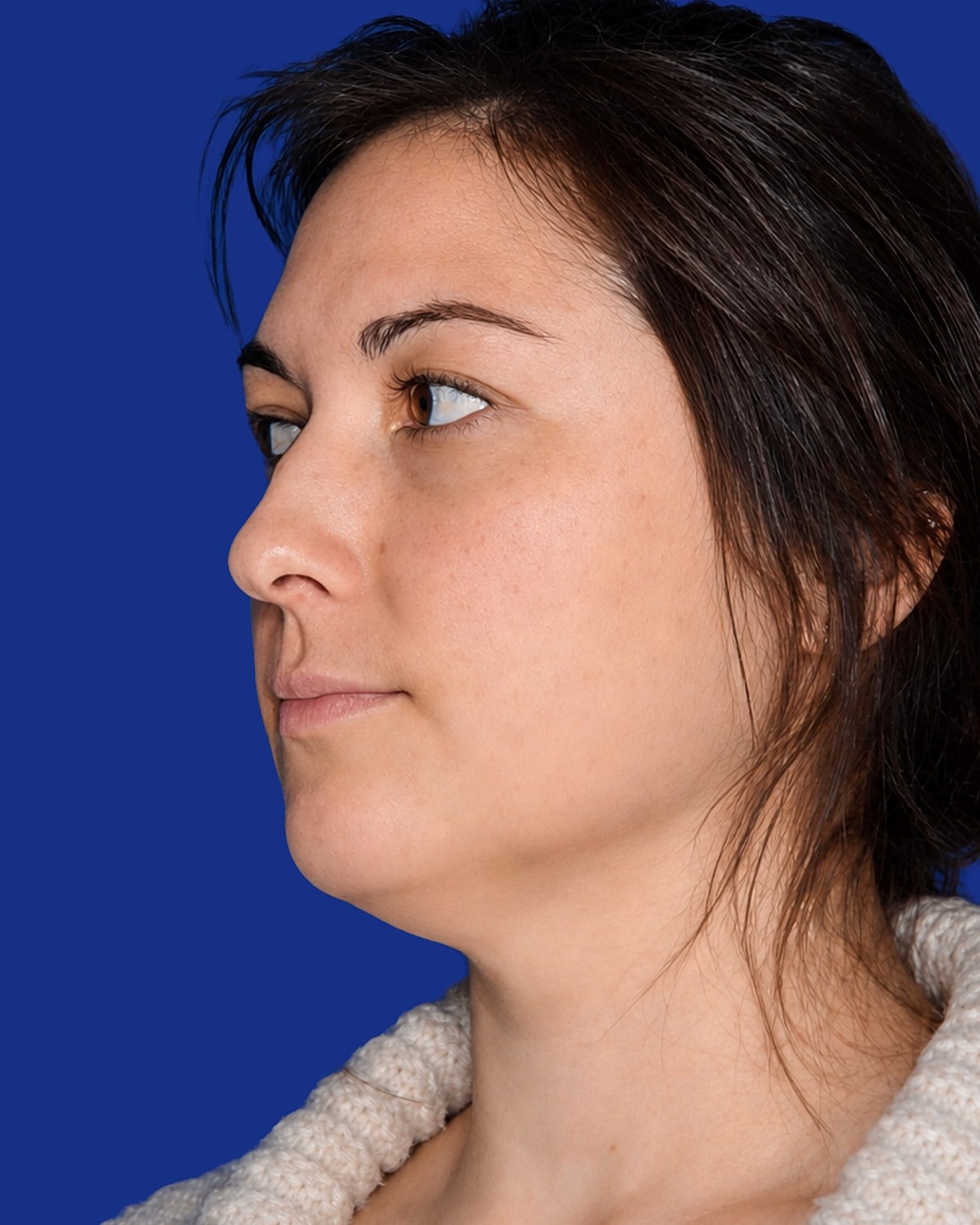 Neck Lift Before & After