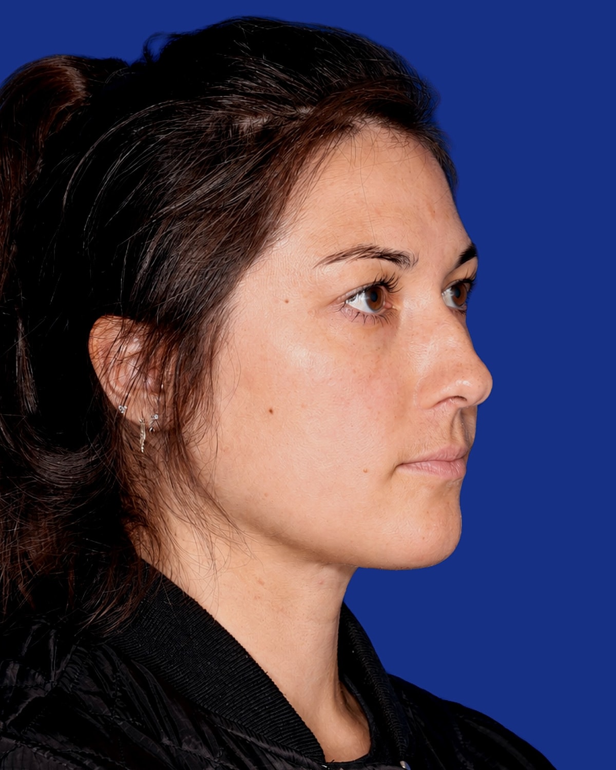Neck Lift Before & After