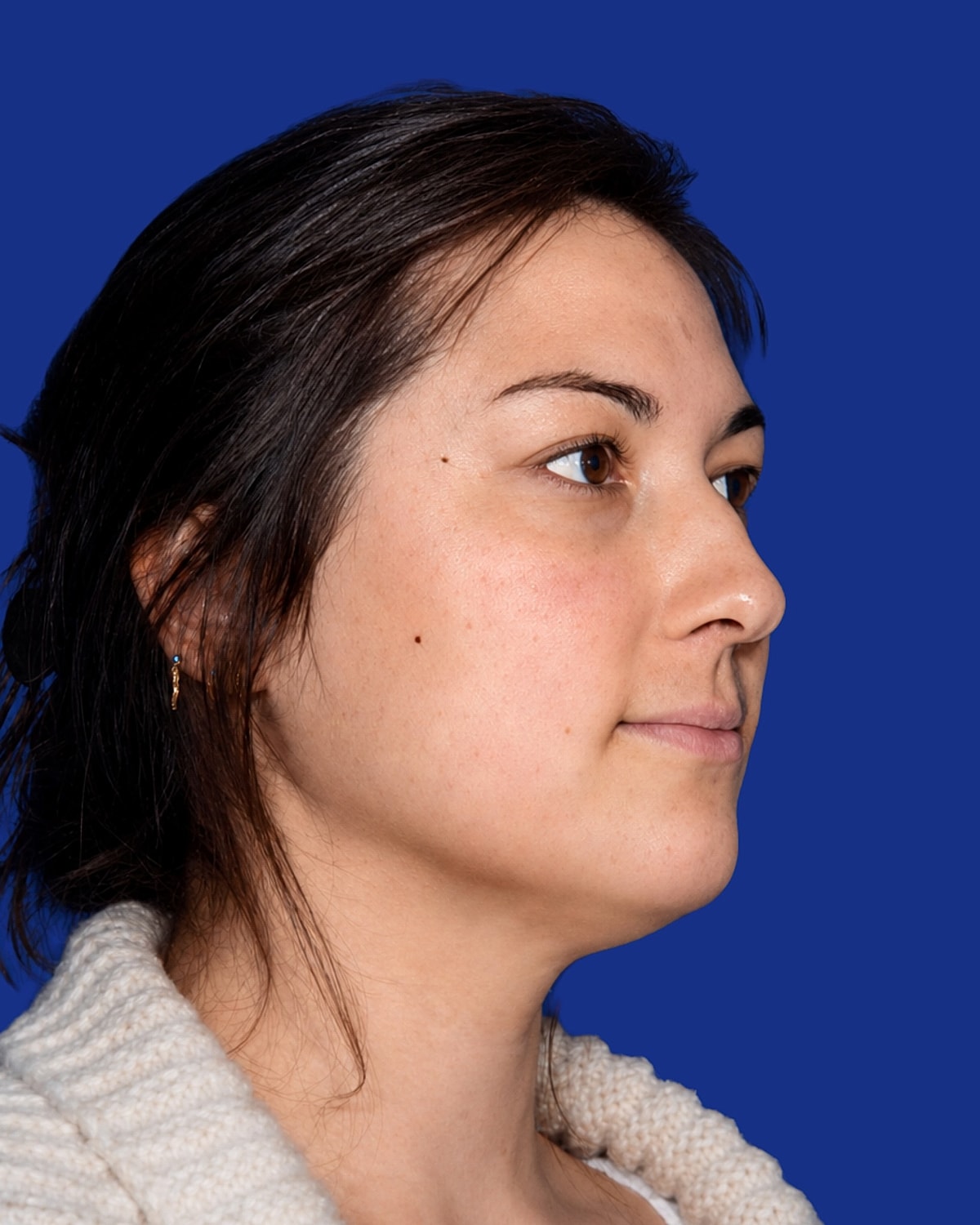Neck Lift Before & After