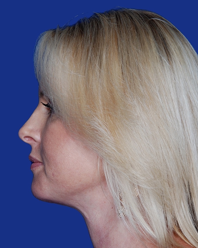 Neck Lift Before & After