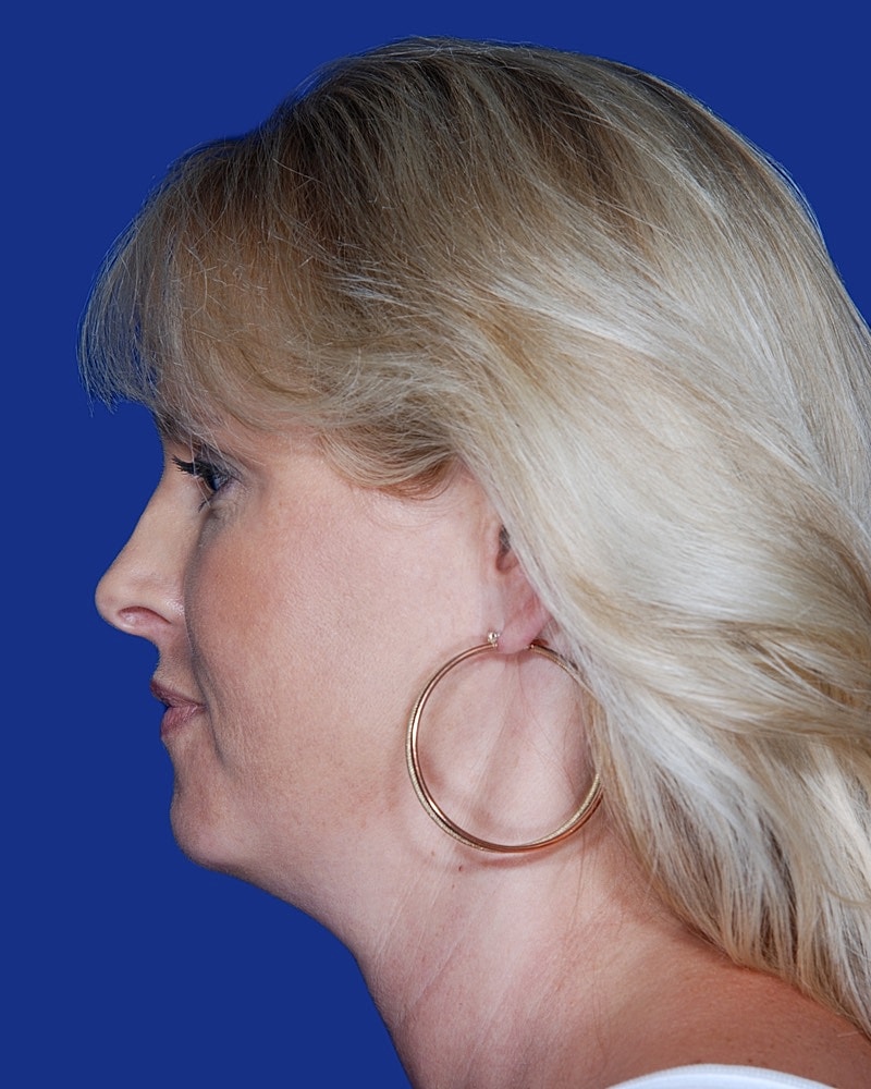 Neck Lift Before & After