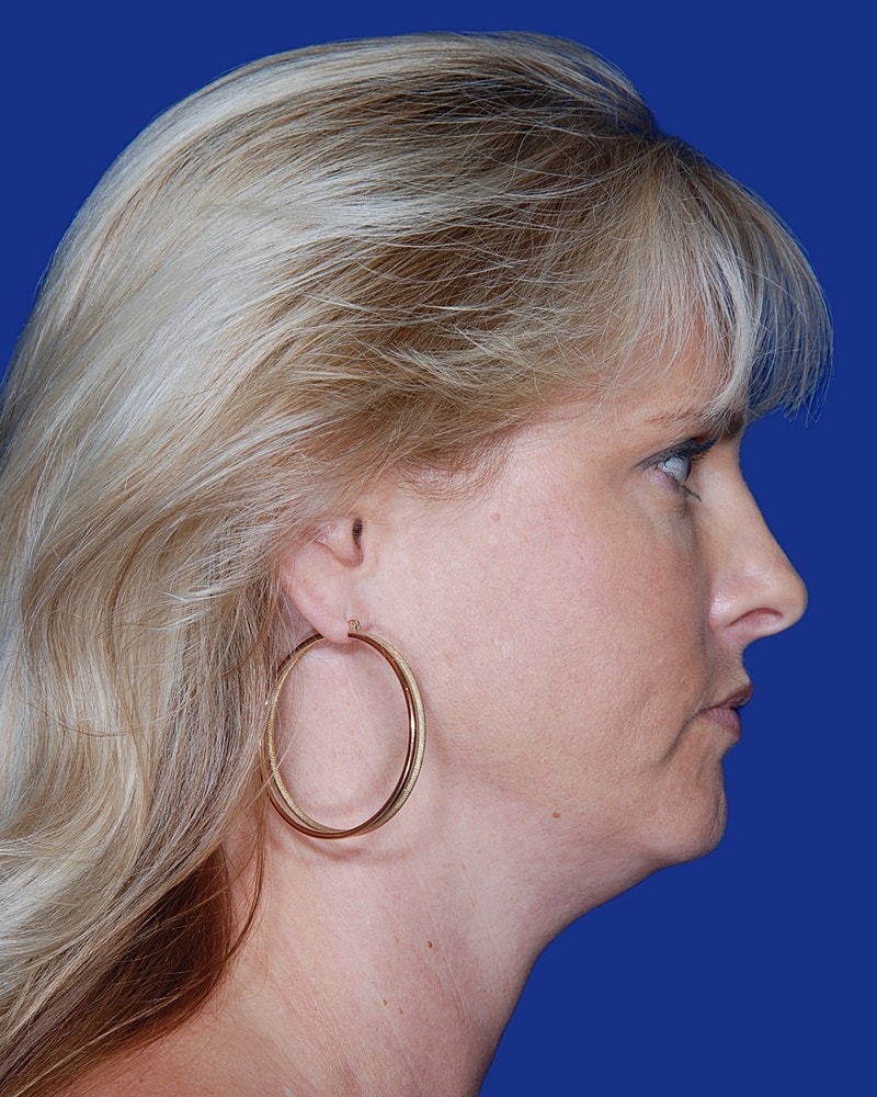 Neck Lift Before & After