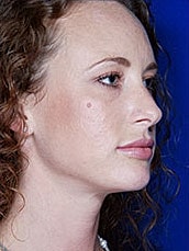 Lip Filler Before & After