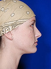 Lip Filler Before & After