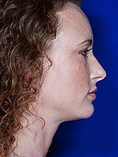 Lip Filler Before & After