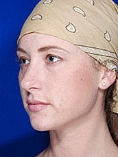 Lip Filler Before & After
