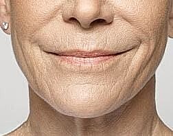 Lip Filler Before & After