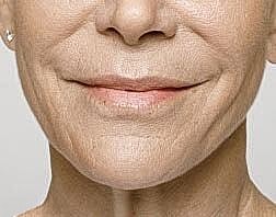 Lip Filler Before & After
