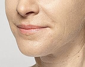 Lip Filler Before & After