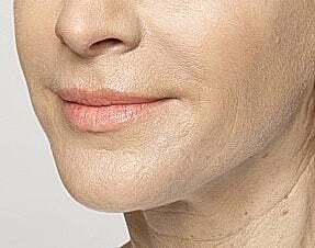 Lip Filler Before & After