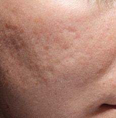 Acne Scar Treatment Before & After