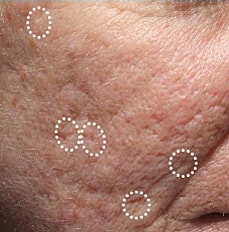 Acne Scar Treatment Before & After