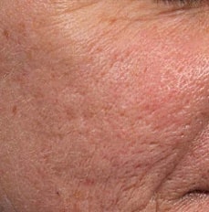 Acne Scar Treatment Before & After