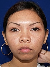 Otoplasty Before & After
