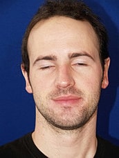 Otoplasty Before & After