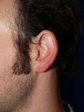 Otoplasty Before & After
