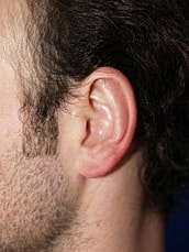 Otoplasty Before & After