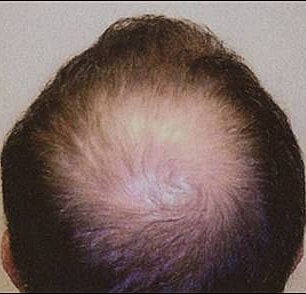 Hair Transplant Before & After